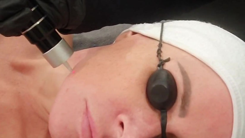 Resurfacing with PicoSecond Laser